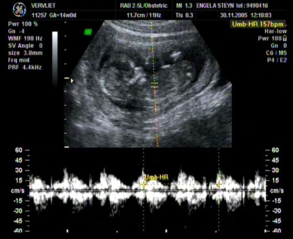 Fetus Heartbeat