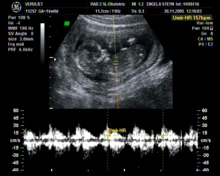 Fetus Heartbeat